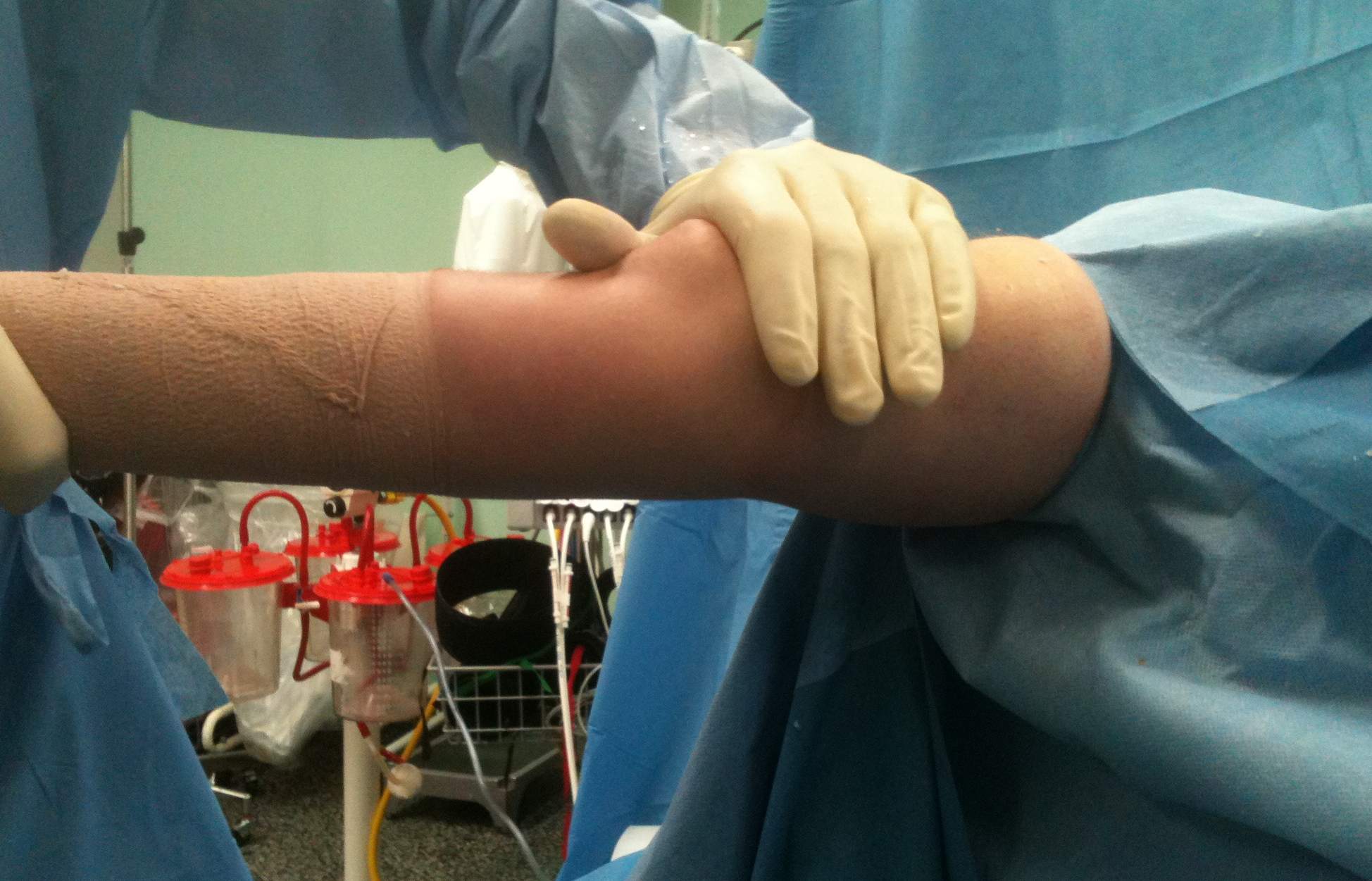 Elbow Malunion Post Op